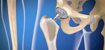 Leadership lessons from hip surgery