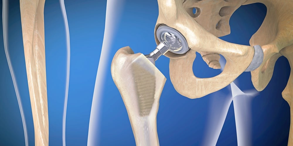 Function Of A Hip Joint Implant Or Hip Prosthesis In Frontal View – 3d Illustration